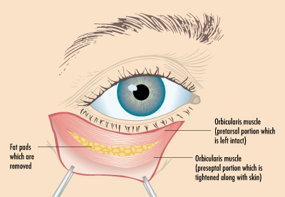 EYE SURGERY
