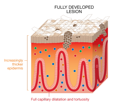 DEVELOPING PSORIASIS