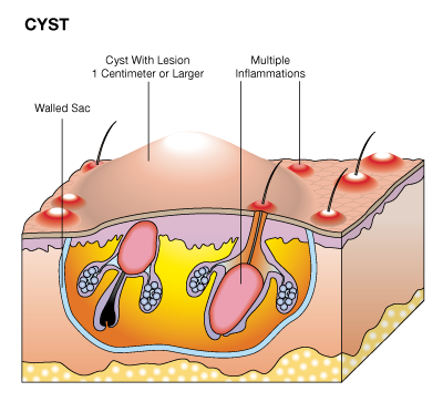 TYPES OF ZITS